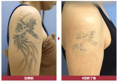 湘南美容外科、タトゥー除去の症例写真1