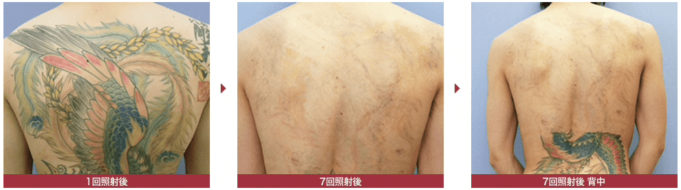 湘南美容外科、タトゥー除去の症例写真2